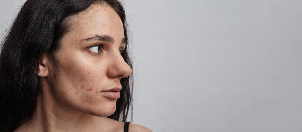 Pigmentation & Dark Spots