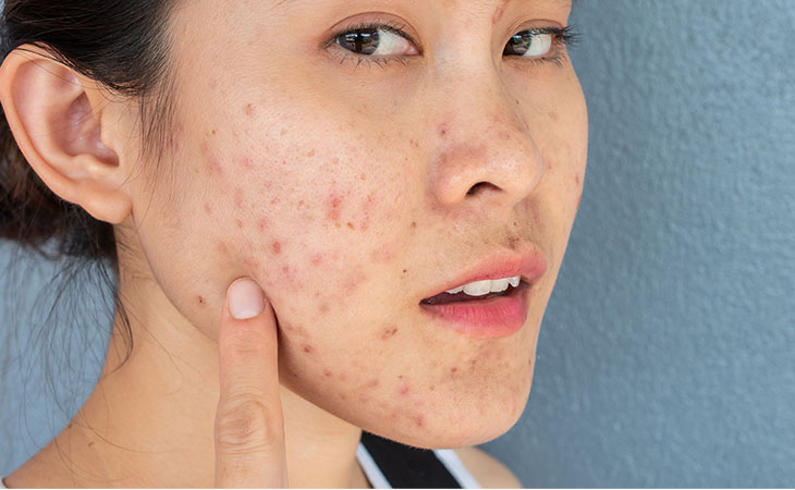Acne & Pimples