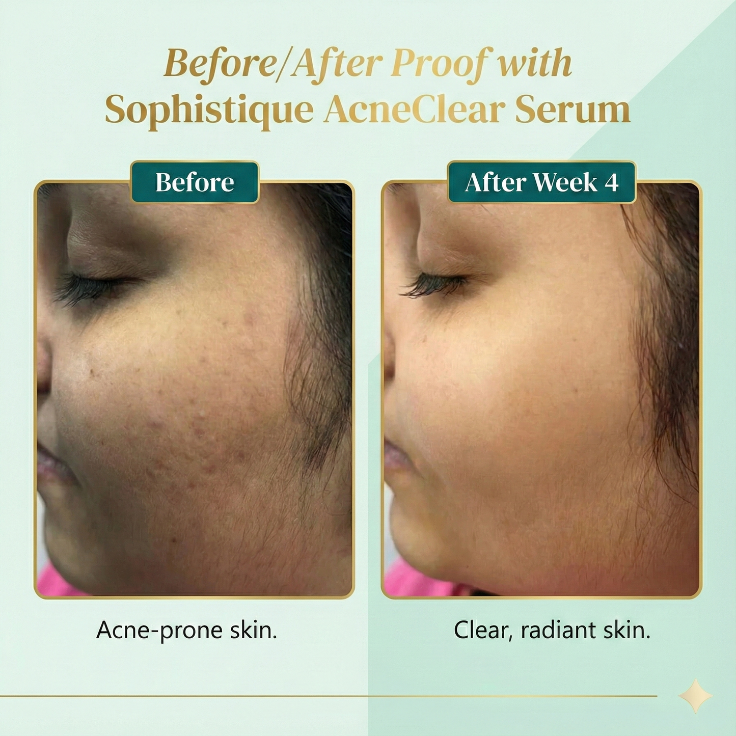 Acne Clear Serum with 2% Salicylic Acid by Sophistique | Clear and acne free skin